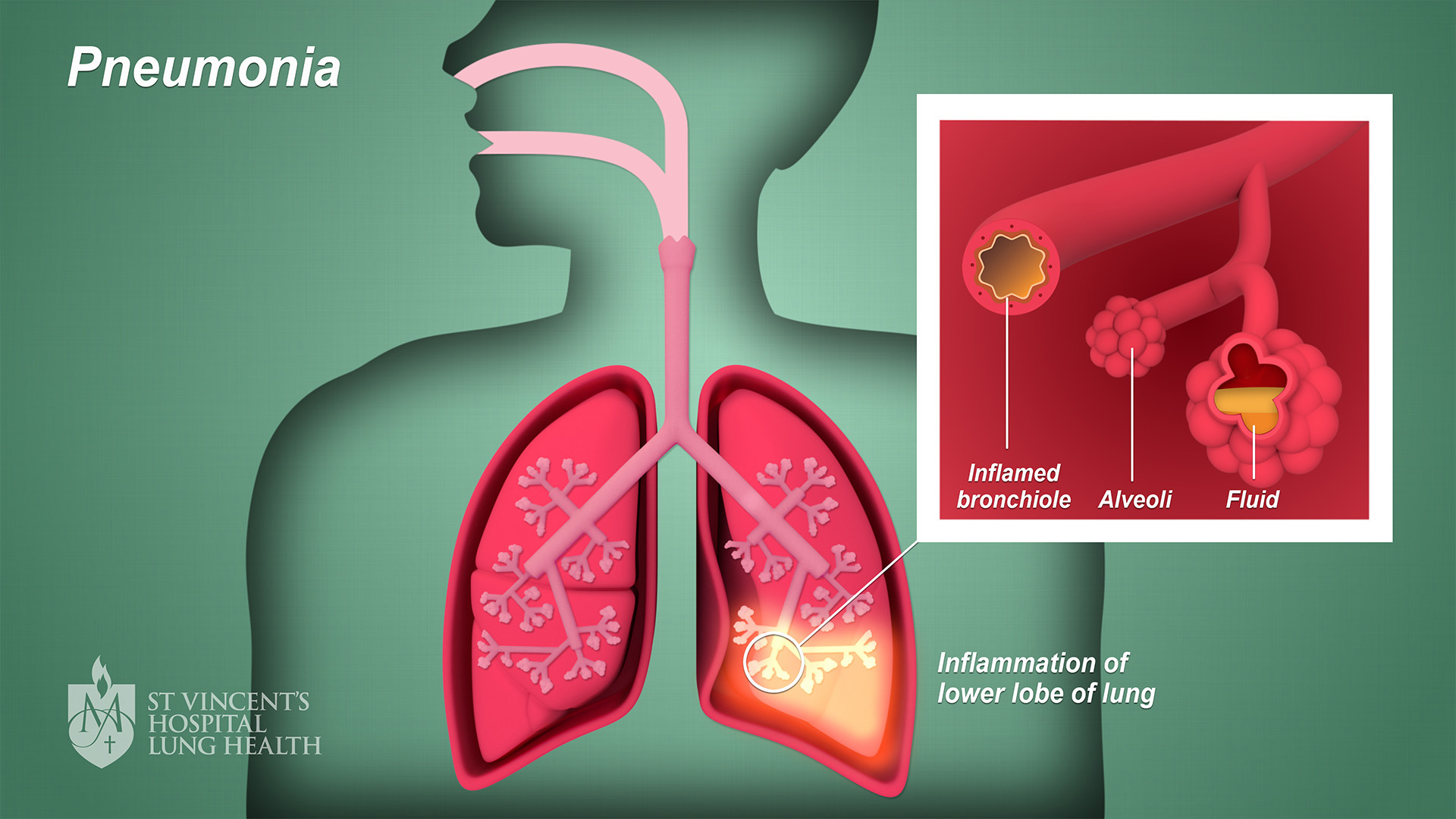 4_SVH_Lung_Health_Pneumonia_final_1080p