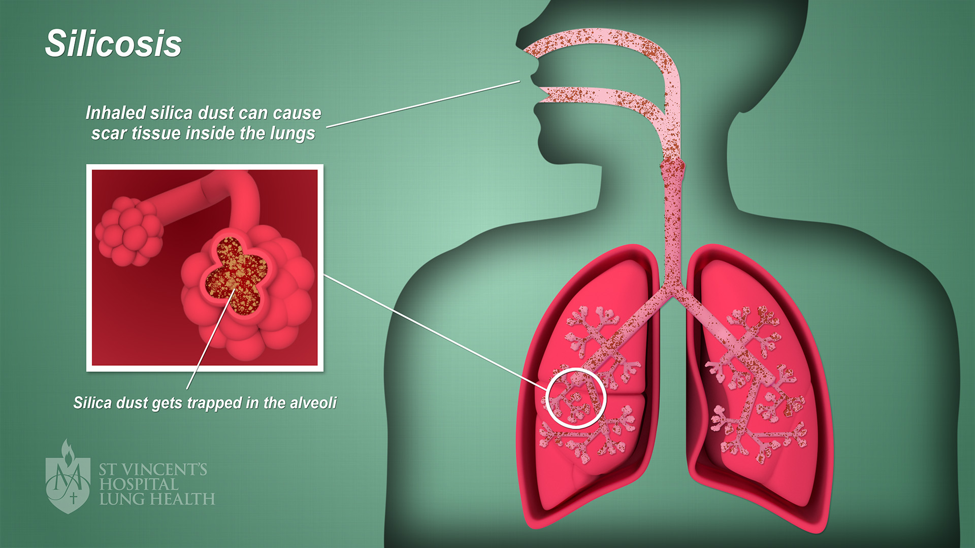 13_SVH_Lung_Health_Silicosis_final_1080p